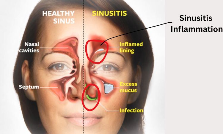 sinusitis in hindi