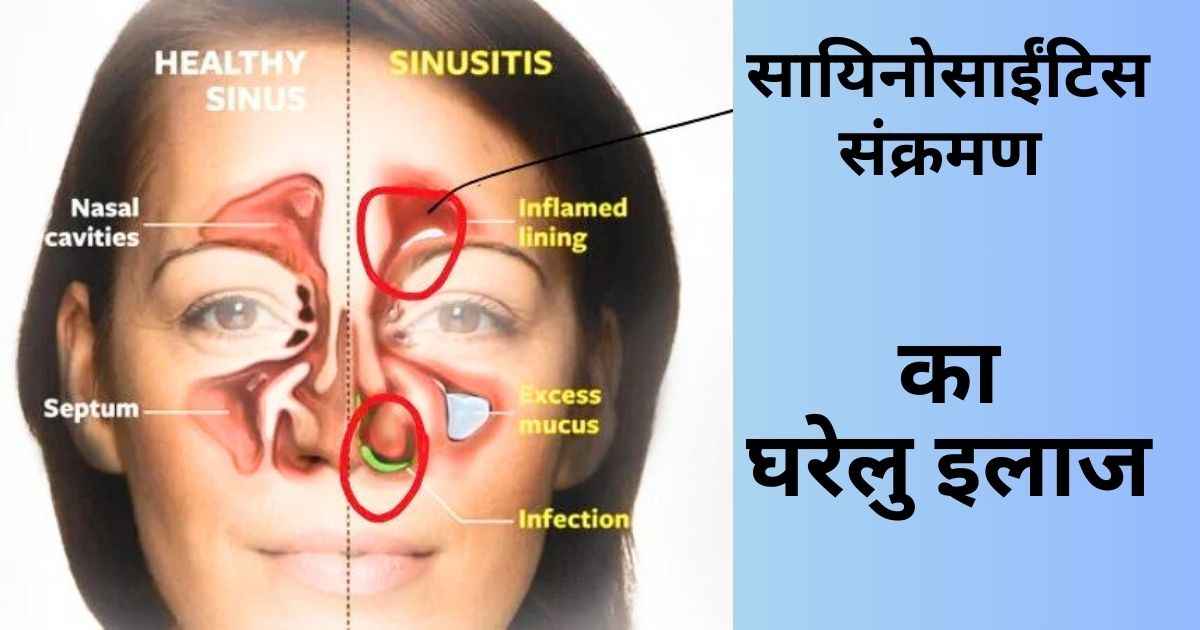 sinusitis in hindi